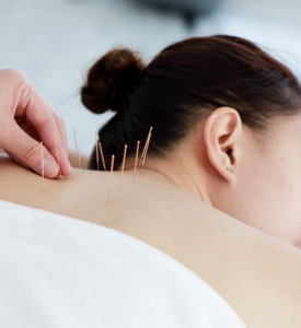 Acupuncture